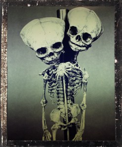 siamese twins skeleton
